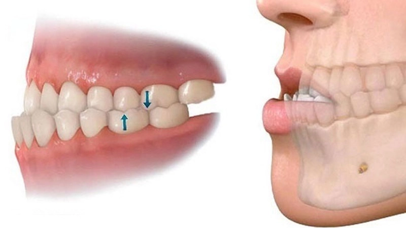 Những trường hợp không nên bọc răng sứ - Lệch khớp cắn mức độ nặng (Sưu tầm)